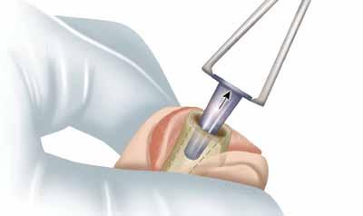 Extracción de los implantes de prueba Retire las superficies