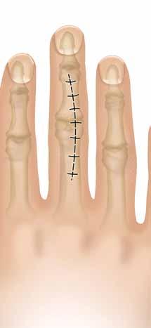 Vías de acceso Gracias a su amplitud de acceso libre de obstáculos, la vía dorsal resulta especialmente recomendable para la implantación de la prótesis Tactys.