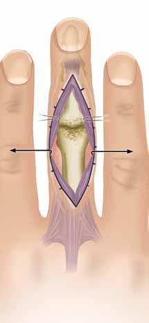 Vía de acceso dorsal transtendinosa* Practique una incisión curvilínea en la piel de 3 a 4 cm a lo largo de la parte posterior de la articulación interfalángica proximal.