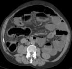 necrosis tumoral ) o en el colon proximal (debido al incremento de presión).