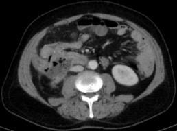 ABSCESO El debut de estos tumores como absceso intrabdominal es raro (0,3-4% ).