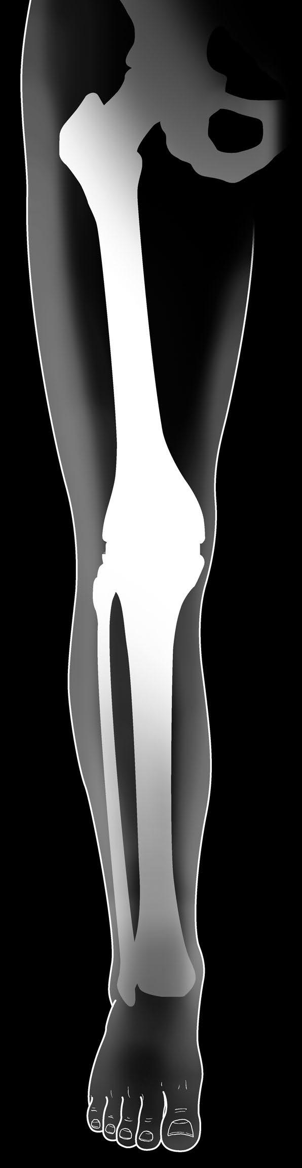 Los extremos del hueso lesionado se revisten con componentes diseñados para volver a crear el contorno natural de los huesos de una rodilla sana.