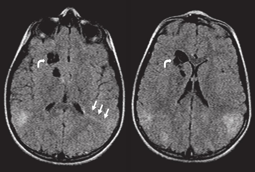 En la tomografía computada se constata que la lesión es hiperdensa en correlación con la calcificación, mientras que en la resonancia magnética es hipointensa en ponderación T2 e hiperintensa en