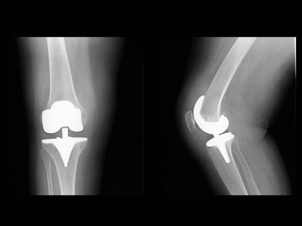 Fig. 2: Fig 2-3. HEMATOMA. Radiografía AP y lateral de rodilla derecha. Prótesis total de rodilla derecha. Área radiolucente en bursa suparpatelar en probable relación con edema.