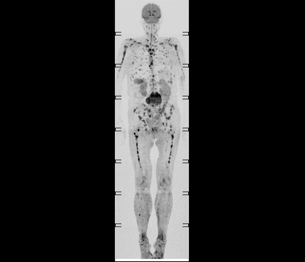 Fig. 1: Se aprecia afectación ósea focal