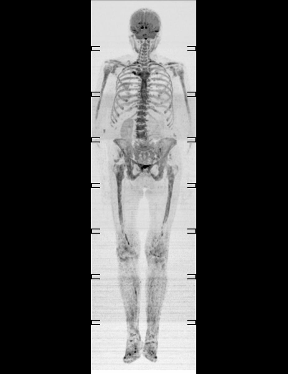 Fig. 2: Afectación ósea difusa en
