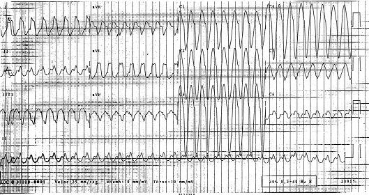 Fig. 4. Taquicardia ventricular. Fig. 5. Fibrilación ventricular. tricular de QRS ancho orienta hacia una taquicardia regular. Exploración física.