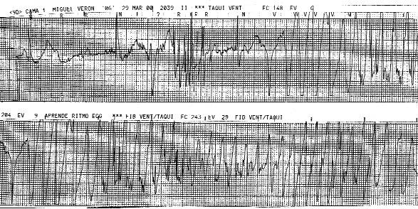 amplitud del pulso variable, ondas venosas «a» cañón) y diagnosticar la cardiopatía estructural asociada (ICC, angina, IAM). Criterios diagnósticos de Brugada.
