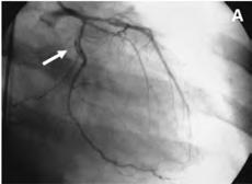 Figura 2. Muestra coroniografía de paciente. (A) Arteria circunfleja con disección amplia. (B) arteria descendente anterior con obstrucción completa en su tercio medio e imagen sugerente de disección.