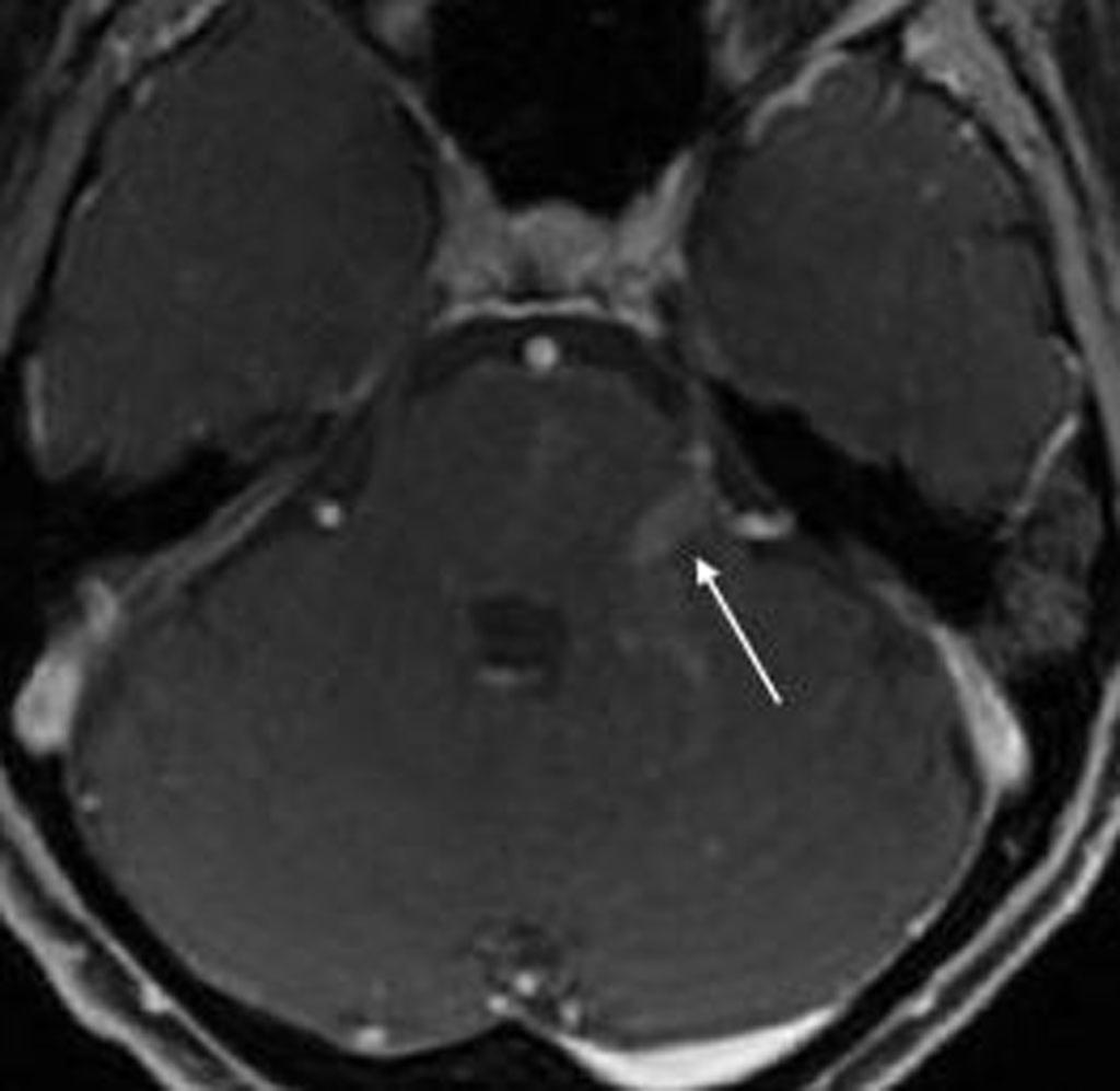 Fig. 4: Varón de 37 años con cefalea, disgeusia y afectación clínica del VII par craneal de manera bilateral y sospecha clínica de rombencefalitis.