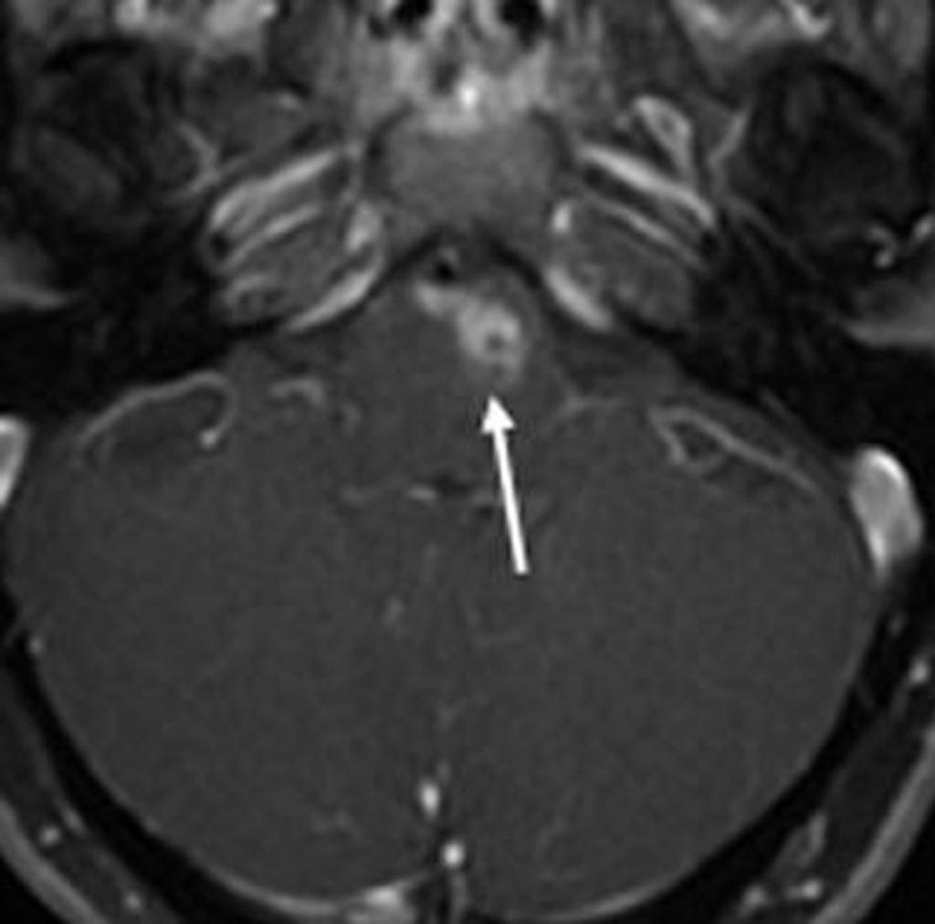 Fig. 5: Mujer de 25 años con cefalea de 5 días de evolución y sospecha clínica de rombencefalitis.