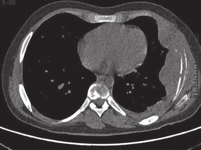 de tejido blando. 4 La biopsia ósea (imágenes 8a, 8b y 8c) determinó el diagnóstico de sarcoma de Ewing.