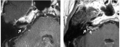 Fig 27.- RMs axiales de dos pacientes que presentaban captación de contraste en el CAI derecho (flechas) que sigue un patrón lineal grueso de difícil diferenciación del patrón nodular.
