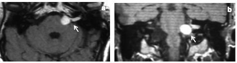 Resultados Fig. 19.- RM con gadolinio en cortes axial (a) y coronal (b) realizada 101 meses tras la primera intervención quirúrgica, en la que se observa recurrencia de SV izquierdo (flechas).