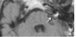 Resultados Fig. 22.- RM con contraste en cortes axial (a) y coronal (b) realizada 52 meses tras la segunda intervención quirúrgica.