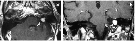 Fig. 24.- RM con contraste en cortes axial (a) y coronal (b) a los 69 meses de la primera intervención quirúrgica respectivamente.