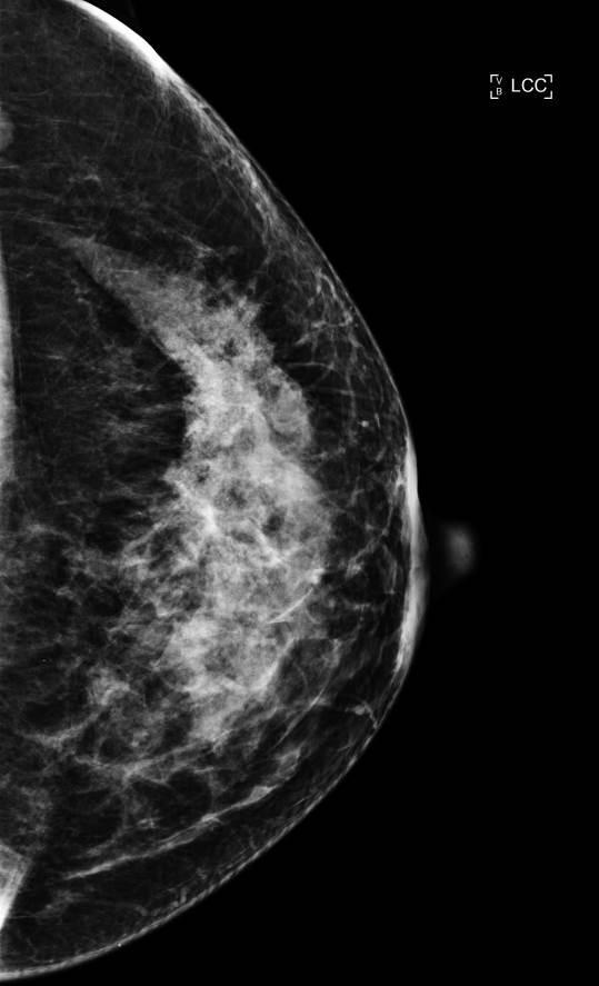 Resultados mamográficos Luminales A Mama