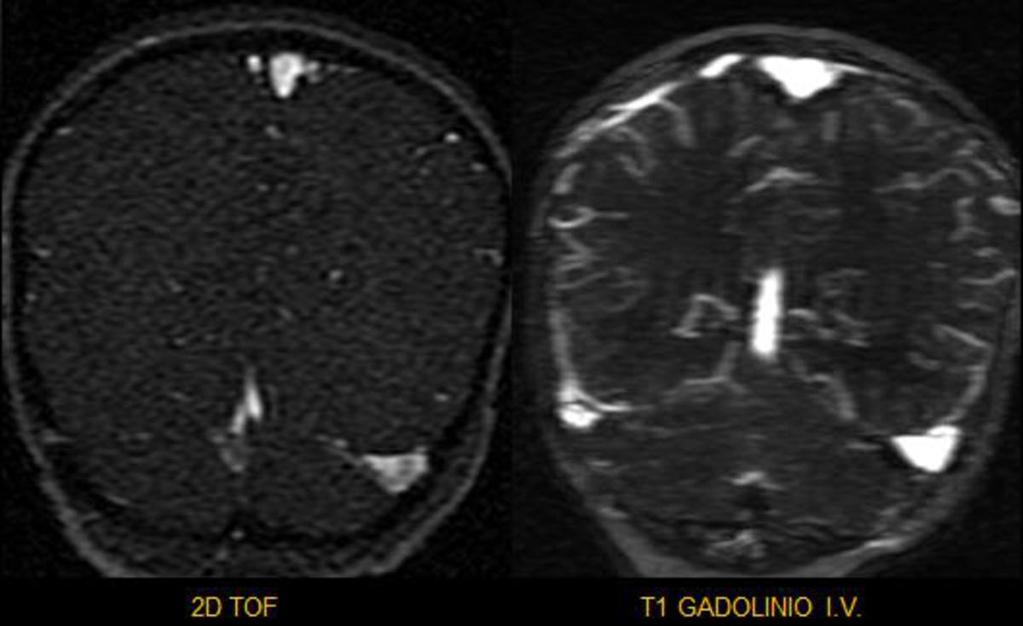 Fig. 6: Angio-RM cerebral, a) 2D TOF senos venosos y b) Reconstrucción MIP plano