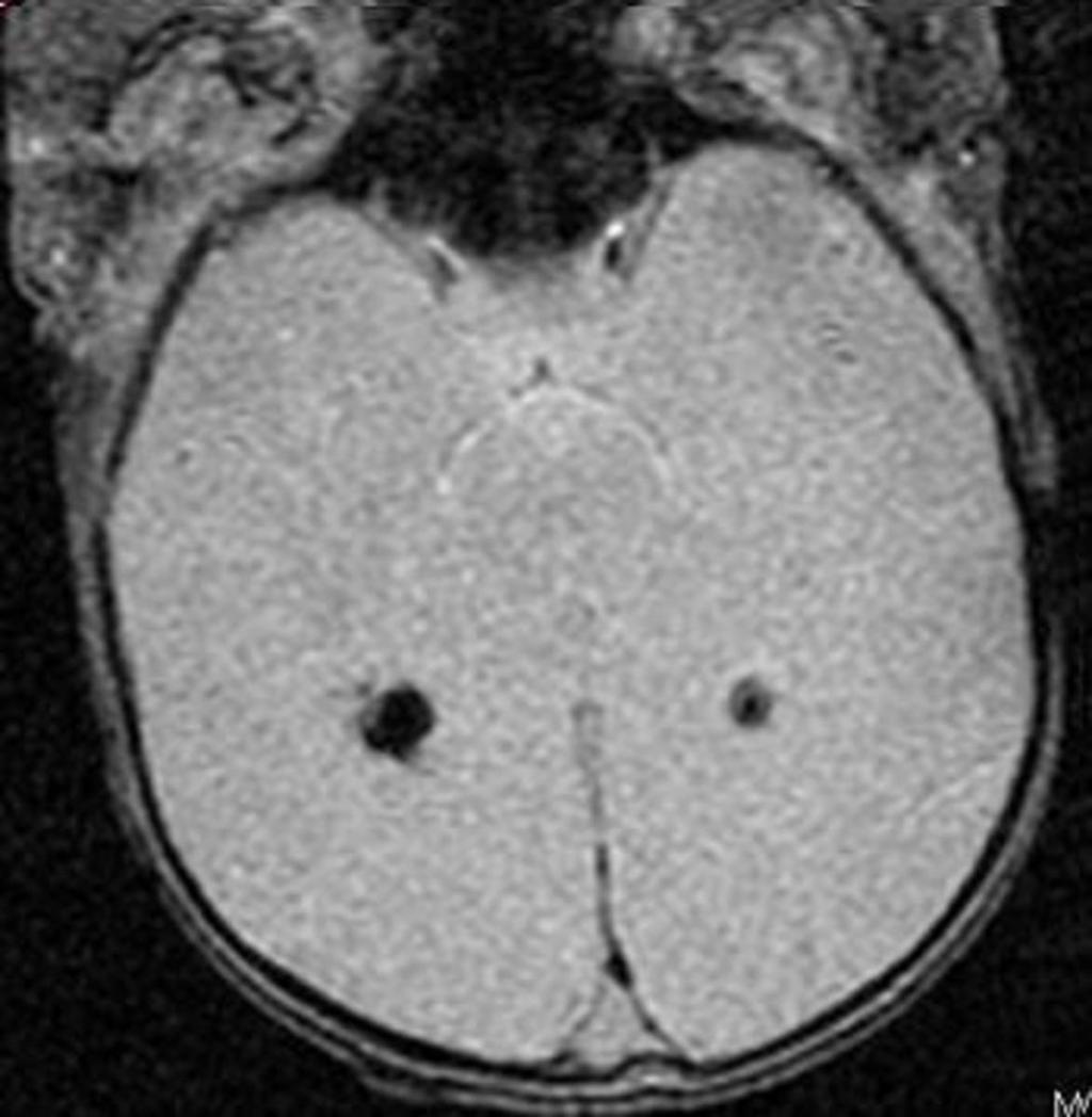 Fig. 17: Paciente de 10 meses con trombosis de la circulación venosa profunda.