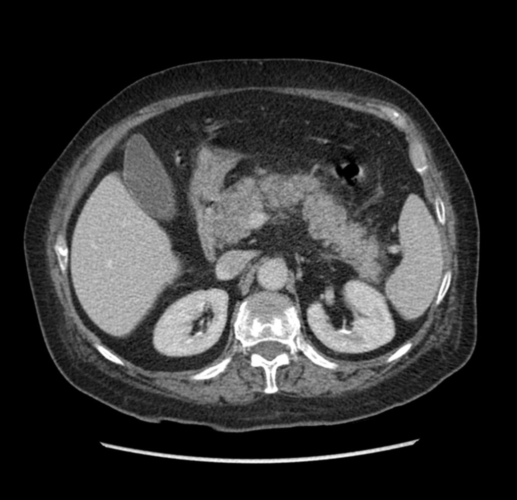 Fig. 1: Corte axial de TC abdominal con CIV en paciente con pancreatitis edematosa.