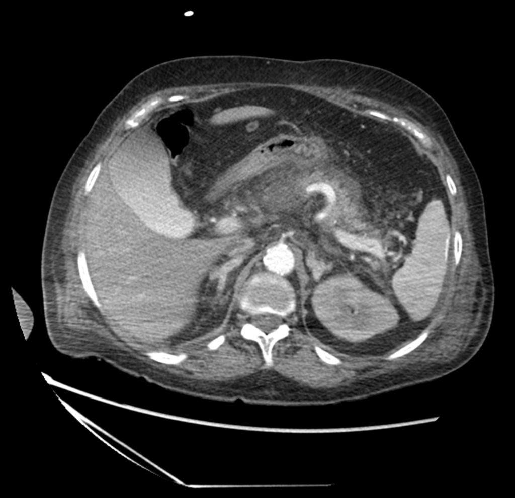 Fig. 6: Corte axial de TC abdominal con CIV en paciente masculino de 72 años con pancreatitis necrotizante aguda.