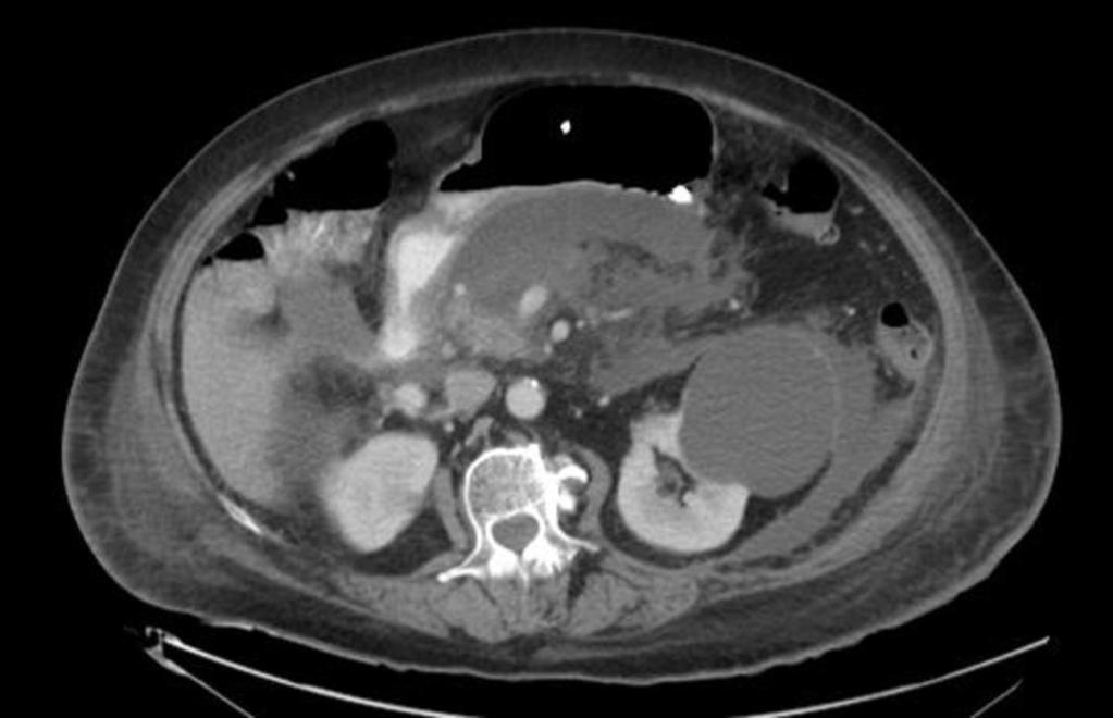 Fig. 3: Corte axial de TC abdominal con CIV. Paciente con pancreatitis aguda necrotizante.