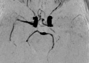 arterial de gran vaso (arteria cerebral media)