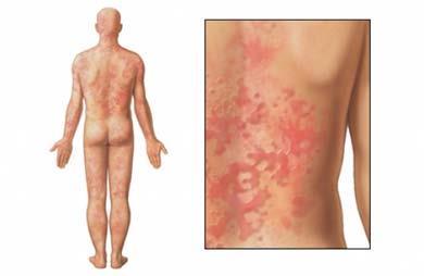 Sintomatología alergias alimentarias: Síntomas cutáneos: urticaria, eritema, prurito, en ocasiones angioedema (párpados, lengua, garganta ).