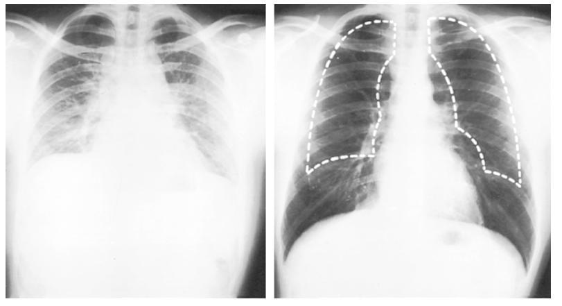 Qué interpreta? *X-ray of chest in full expiration (left) and full inspiration (right).