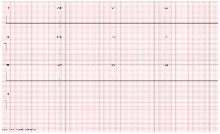 Al identificar ACTIVIDAD ELÉCTRICA SIN PULSO, se entiende que es un trazo electrocardiográfico bien organizado (Ver imagen 5), en ocasiones similar al ritmo sinusal, lo que dará la pauta es la