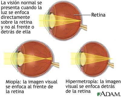 Enfermedades de la vista La miopía y la hipermetropía se deben a la deformación del globo ocular, por lo cual las imágenes no llegan a la retina.
