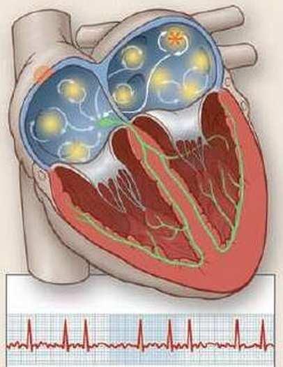 CONCEPTO La cardioversíón eléctrica libera una carga de energía sincronizada