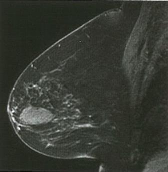 Masas Morfología Oval Redondo Irregular American College of Radiology (ACR) Breast Imaging