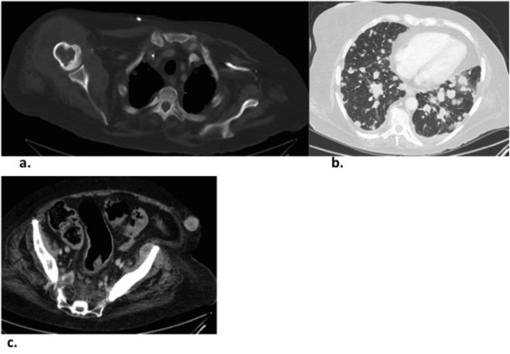 Fig. 9: Figura 9. Metástasis óseas, pulmonares y de partes blandas de paciente con el diagnóstico de TMNP. (a) Afectación del húmero derecho con masa de partes blandas asociada.