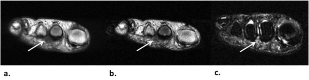 Fig. 2: Figura 2. Neuroma de Morton en el segundo espacio intermetatarsal del pie derecho en una mujer de 58 años (flechas).