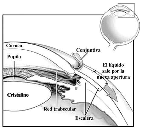 Causas del glaucoma Figura 2: Corte transversal del globo ocular que muestra por donde se realiza el túnel esclerocorneal, que permite la comunicación de la cámara anterior con el espacio