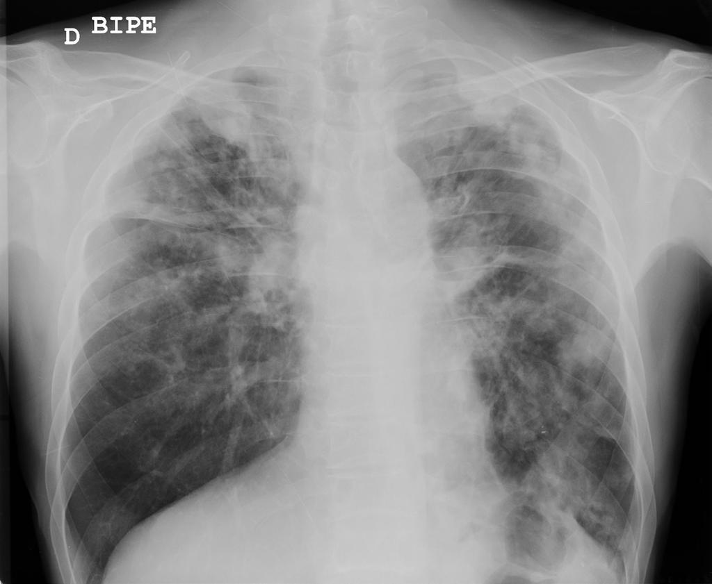 Tuberculosis y cáncer: están relacionados?
