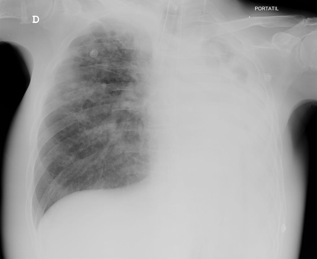 Tras la inhalación de M. tuberculosis pueden desencadenarse varias situaciones: Un inmediato aclaramiento del organismo.