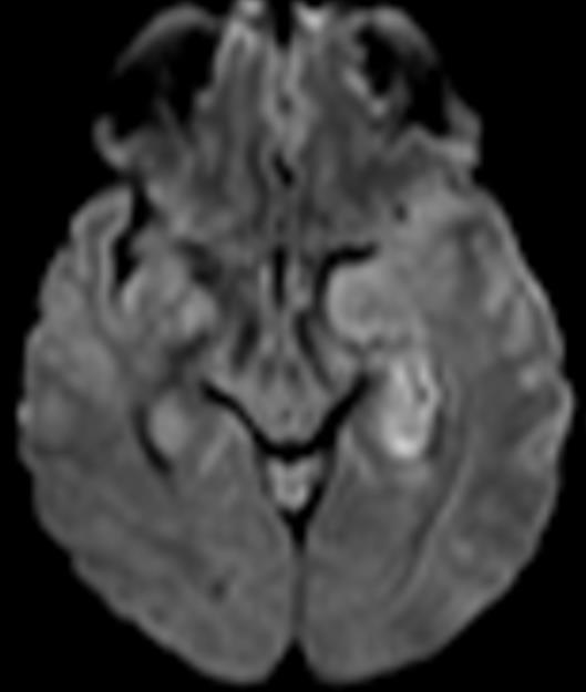STATUS EPILEPTICUS ESCLEROSIS MESIAL TEMPORAL Edema cerebral transitorio y en la sustancia gris +/- afectación subcortical