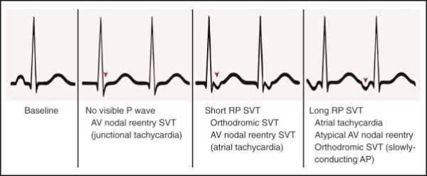 Ubicación relativa de la onda P dentro del intervalo R-R: Cuando no se distingue onda P clara, traduce activación simultánea auricular y ventricular, sugiriendo TRNAV Midiendo el RP Cuando la