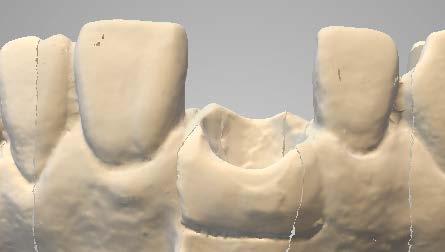 1.8 Líneas de separación de los dientes adyacentes Ya no son