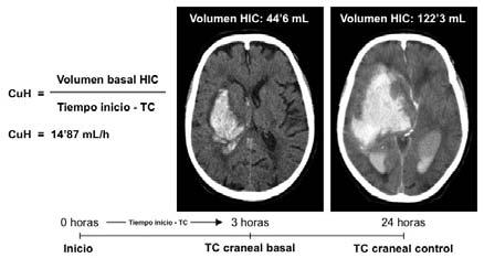 Figura 11. Caso ejemplo de crecimiento ultraprecoz del hematoma Paciente con un volumen basal de HIC de 44 6 ml y tiempo desde inicio de síntomas hasta TC de 3 horas.