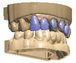 º de elemento: 80247010 + 80247011) Incluido GRATUITAMENTE Escaneos de laboratorio de Dental Wings No requiere complemento si los escaneos están seccionados Model Builder STL