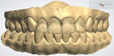 Visualización de los dientes originales para el encerado de diagnóstico físico Disponible con Dental System 20