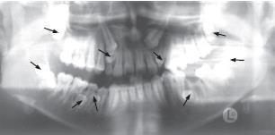 Los que pueden invadir y proyectarse a los senos parafaciales. También se han descritos casos de limitación de la apertura bucal y latero desvío por localización a nivel del cóndilo mandibular.
