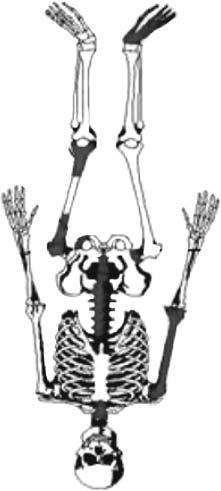Frecuencia de neoplasias óseas en adultos maduros y adultos mayores Tabla 3. Metástasis óseas en adultos maduros y adultos mayores. Columna 18.1% Fémur proximal 9% Isquión 18.1% Fémur distal 13.