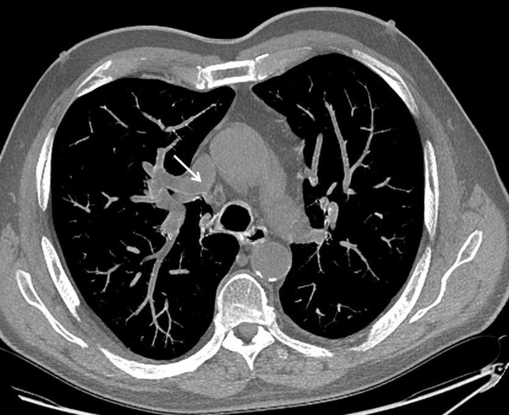 Fig. 10: Imagen axial con MIP que muestra drenaje venoso pulmonar anómalo parcial derecho. Vena pulmonar del lóbulo superior derecho desemboca en la vena cava superior. 5.