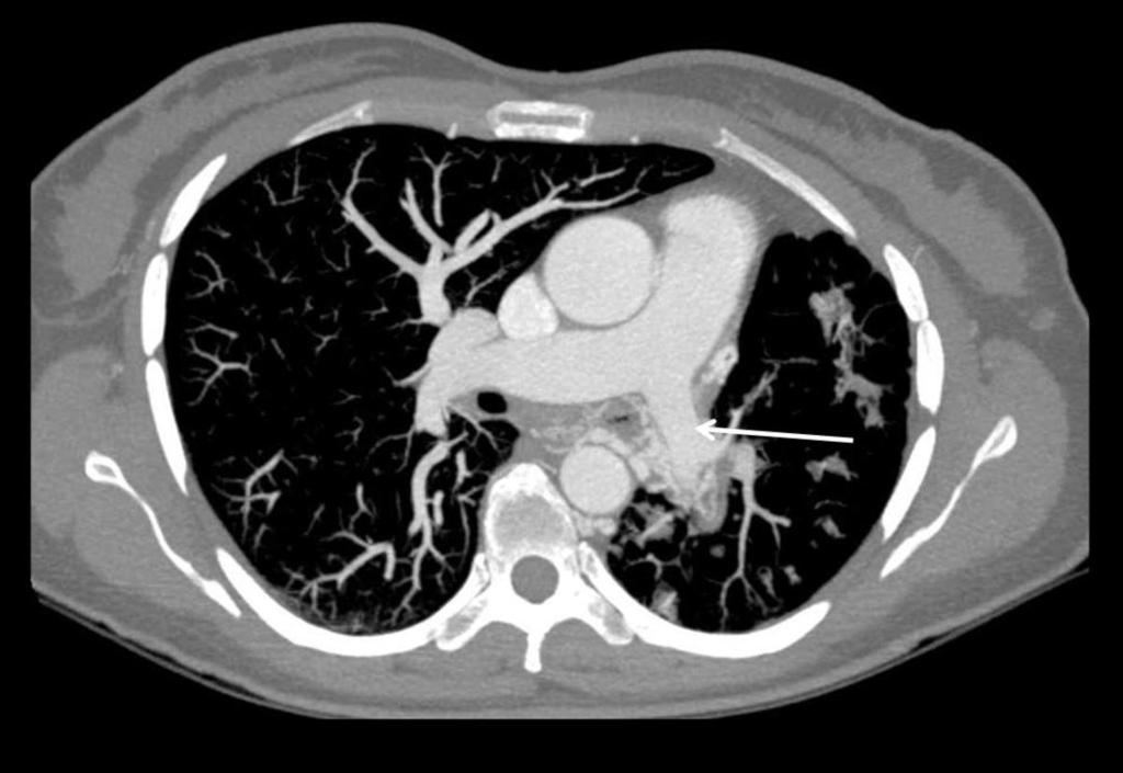 Fig. 12: Imagen axial con MIP que muestra hipoplasia de arteria pulmonar izquierda (flecha).