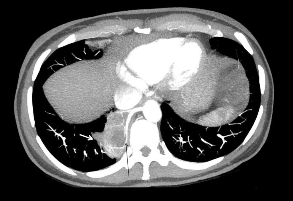 Fig. 1: Imagen axial de TCMD con MIP que muestra una masa pulmonar localizada en segmento basal medial de LID (flecha blanca) con aporte arterial sistémico que proviene de la pared lateral derecha de