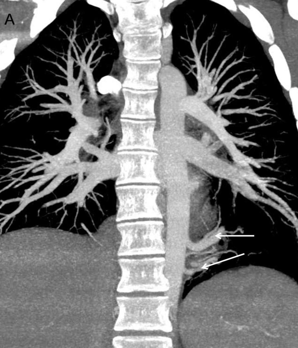 Fig. 3: Secuestro pulmonar extralobar. A. Imagen coronal MIP.